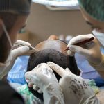 Benefits of Getting a FUE Hair Transplant
