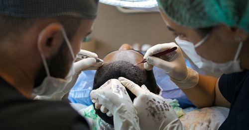Benefits of Getting a FUE Hair Transplant